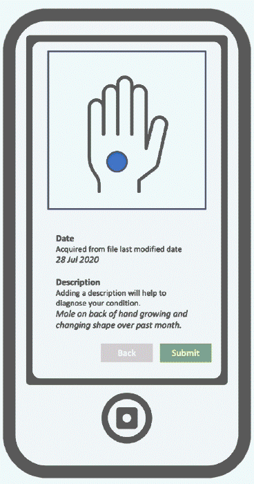This is cartoon representation of a phone with a picture of a skin lesion with detailed description underneath as it would be presented in the Digital Dermatology app
