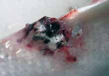 extreme red vent syndrome