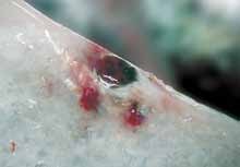 mild red vent syndrome