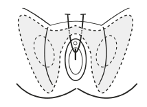 Vaginal mesh tape procedures for urinary incontinence: Retropubic tape