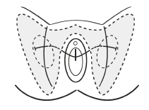 Vaginal mesh tape procedures for urinary incontinence: Transobturator tape