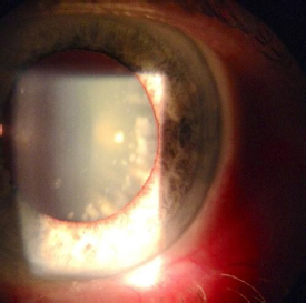 Cataract eye examination